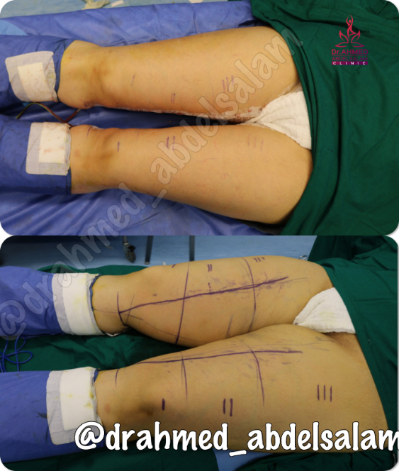 cases in Thigh Lift