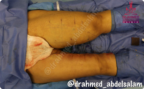 cases in Thigh Lift