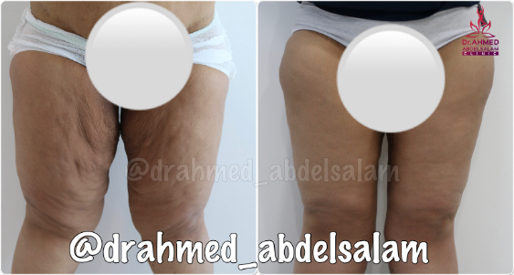 cases in Thigh Lift