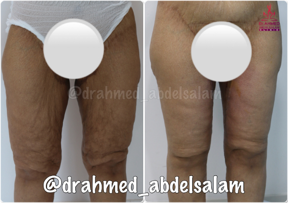 cases in Thigh Lift