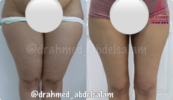 cases in Thigh Lift