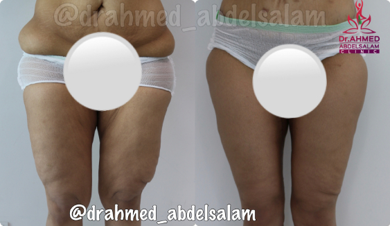 cases in Thigh Lift