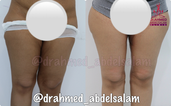 cases in Thigh Lift