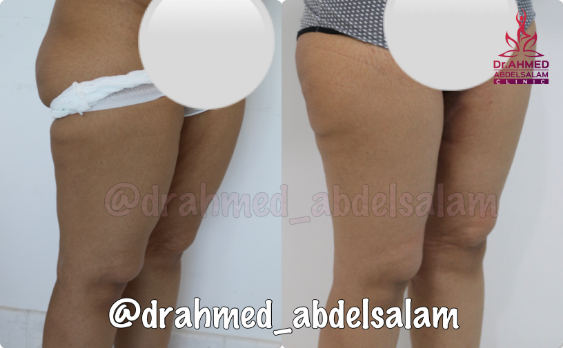 cases in Thigh Lift