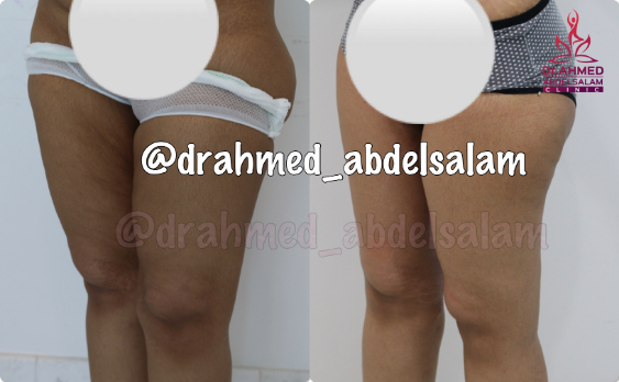 cases in Thigh Lift