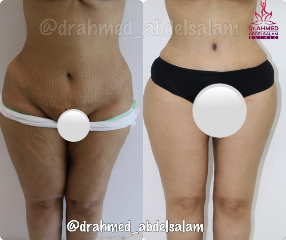 cases in Thigh Lift