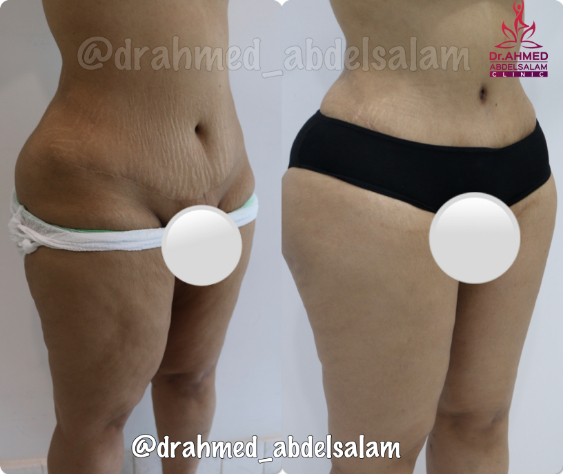 cases in Thigh Lift