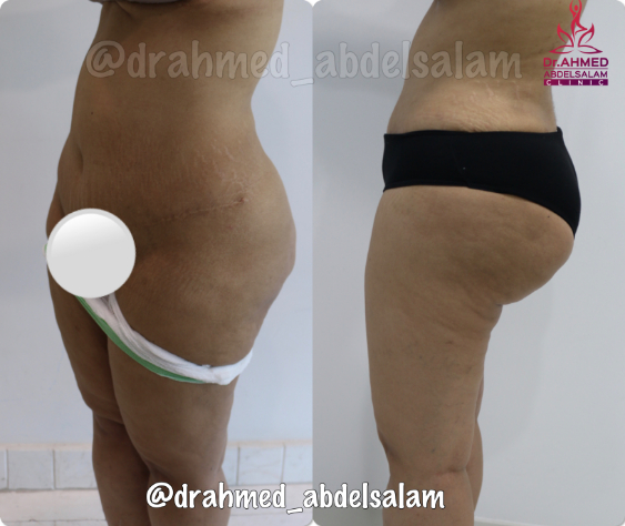 cases in Thigh Lift