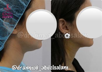 Face & Neck Lift