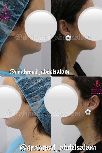 Face & Neck Lift