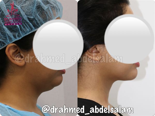 Face & Neck Lift