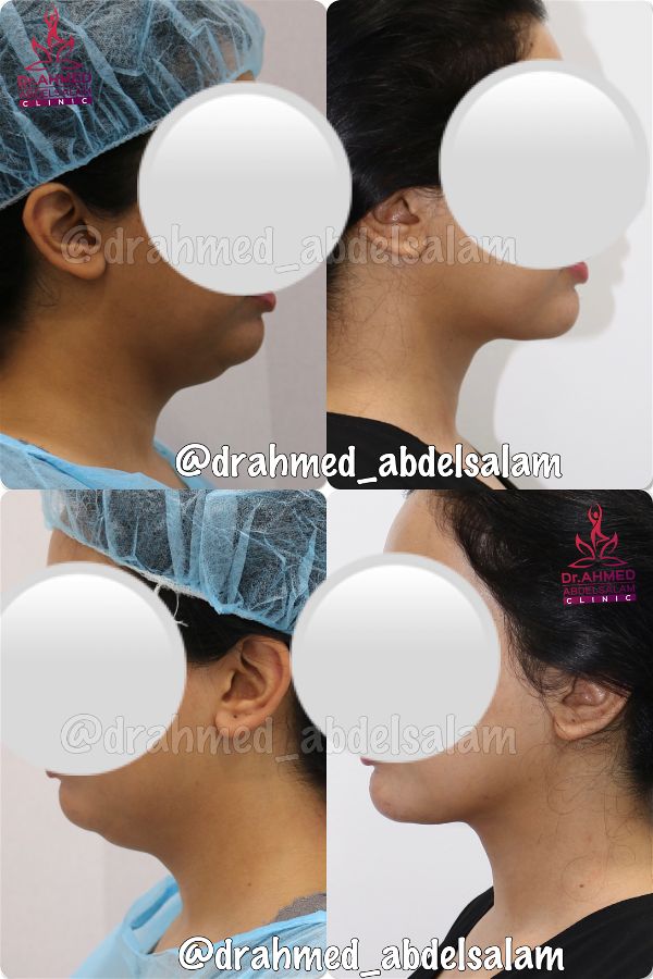 Face & Neck Lift