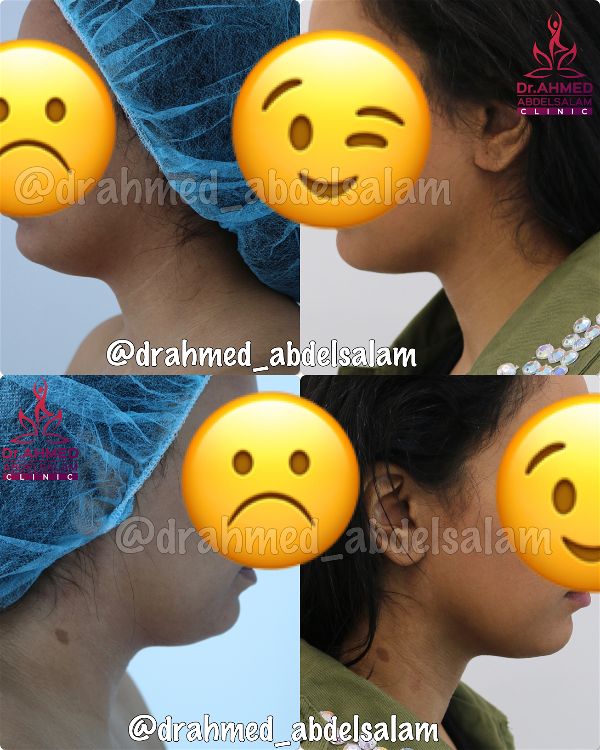 Face & Neck Lift