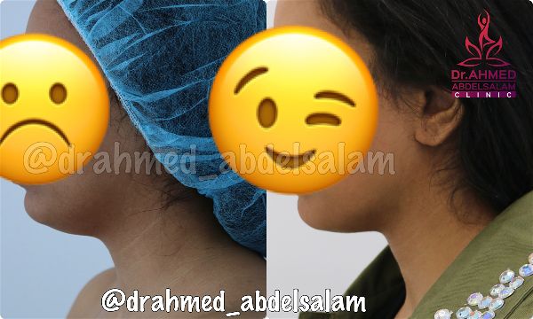 Face & Neck Lift