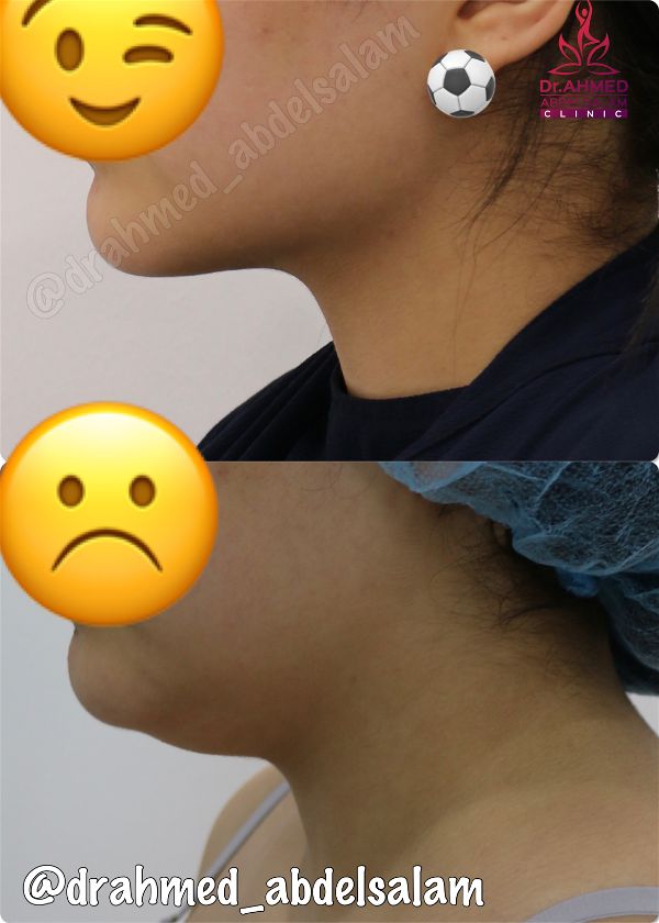 Face & Neck Lift