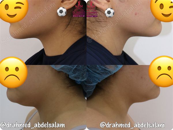 Face & Neck Lift