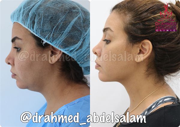 Face & Neck Lift