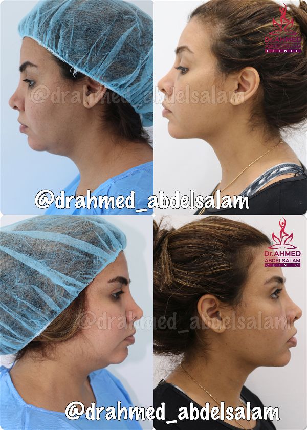 Face & Neck Lift