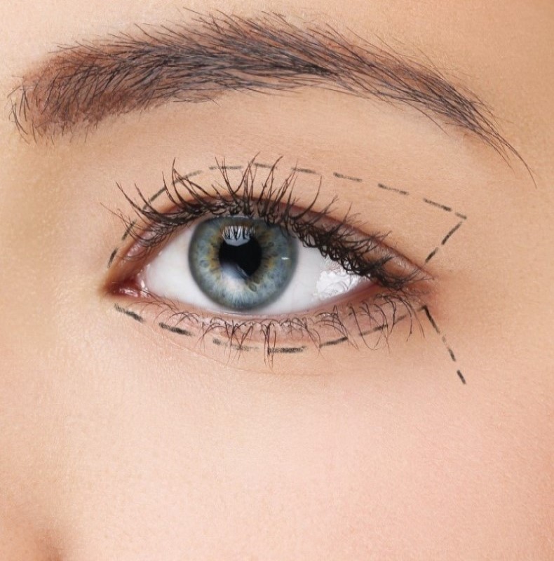 Upper & Lower Blepharoplasty