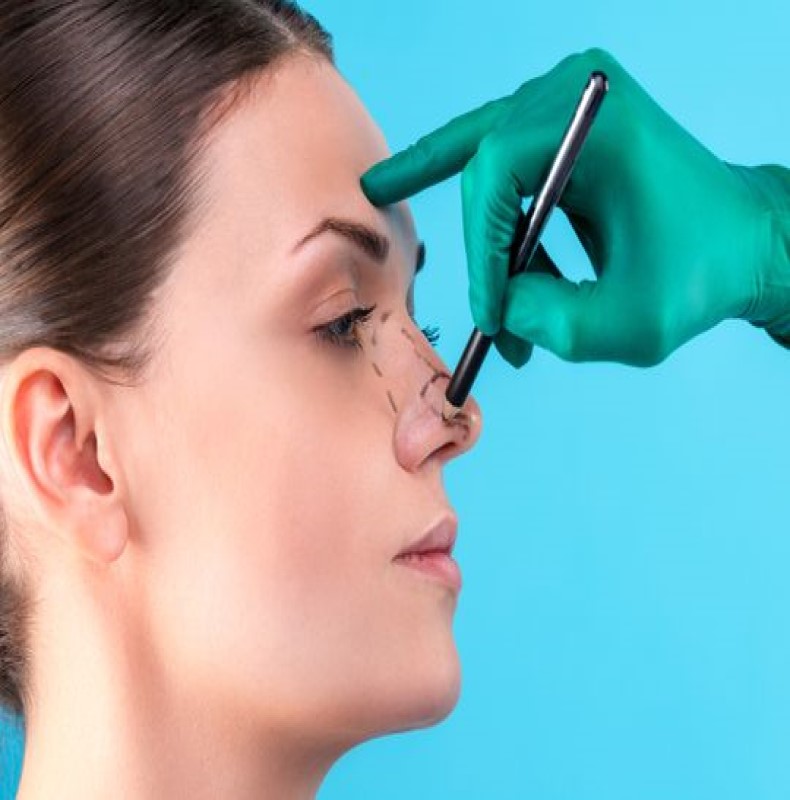 Rhinoplasty