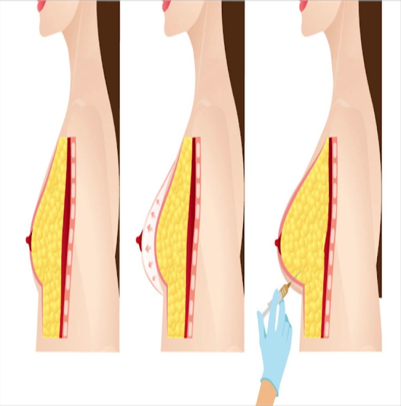 Fat Transfer to the Breast