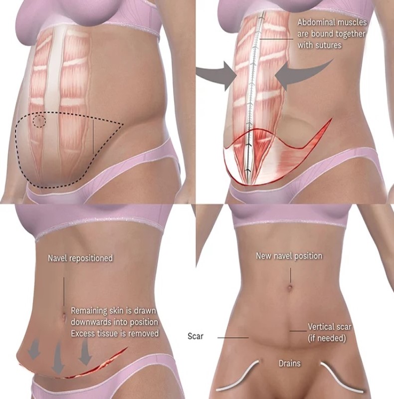 Abdominoplasty